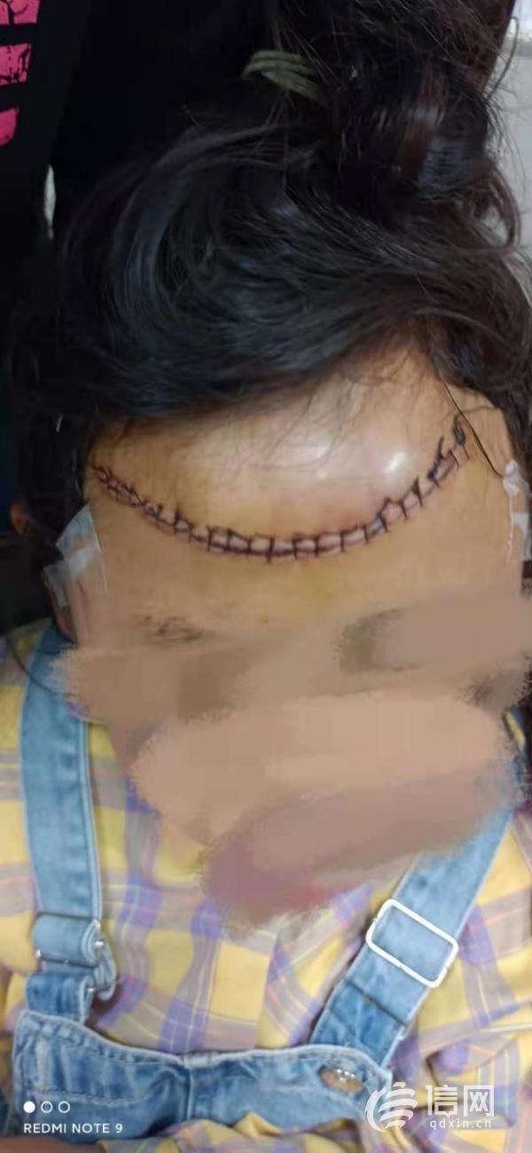 6岁女孩被玻璃门砸伤,5岁女童被酒店玻璃砸伤