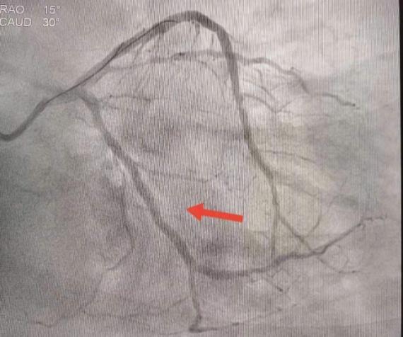 男子突发心梗万幸民警医护在场,男子突发心梗救护士