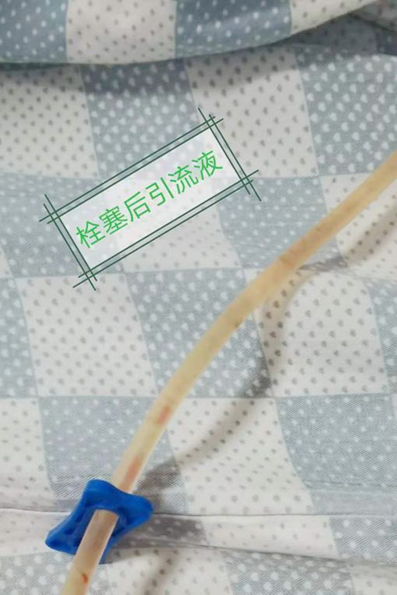 微创免费治疗成功案例,微创淋巴手术