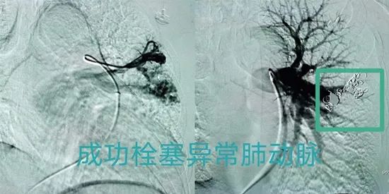 肺动静脉畸形介入手术成功率,肺动静脉畸形介入手术全过程
