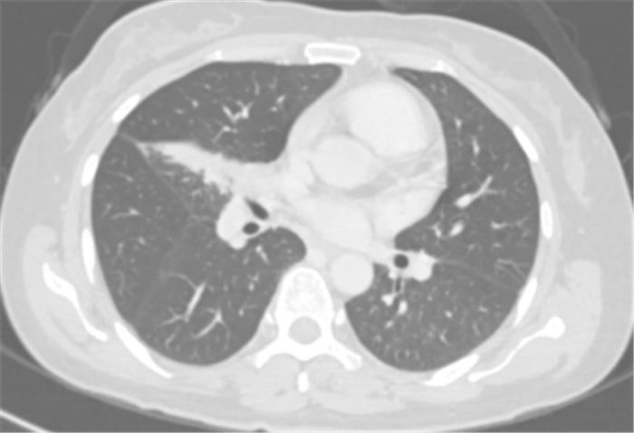 肿瘤的姑息治疗或辅助治疗根治,肿瘤的免疫治疗和介入治疗