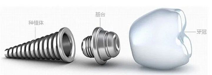 半岛叨叨丨种植牙动辄上万,一颗假牙成本才百元?