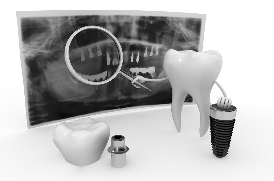 半岛叨叨丨种植牙动辄上万,一颗假牙成本才百元?