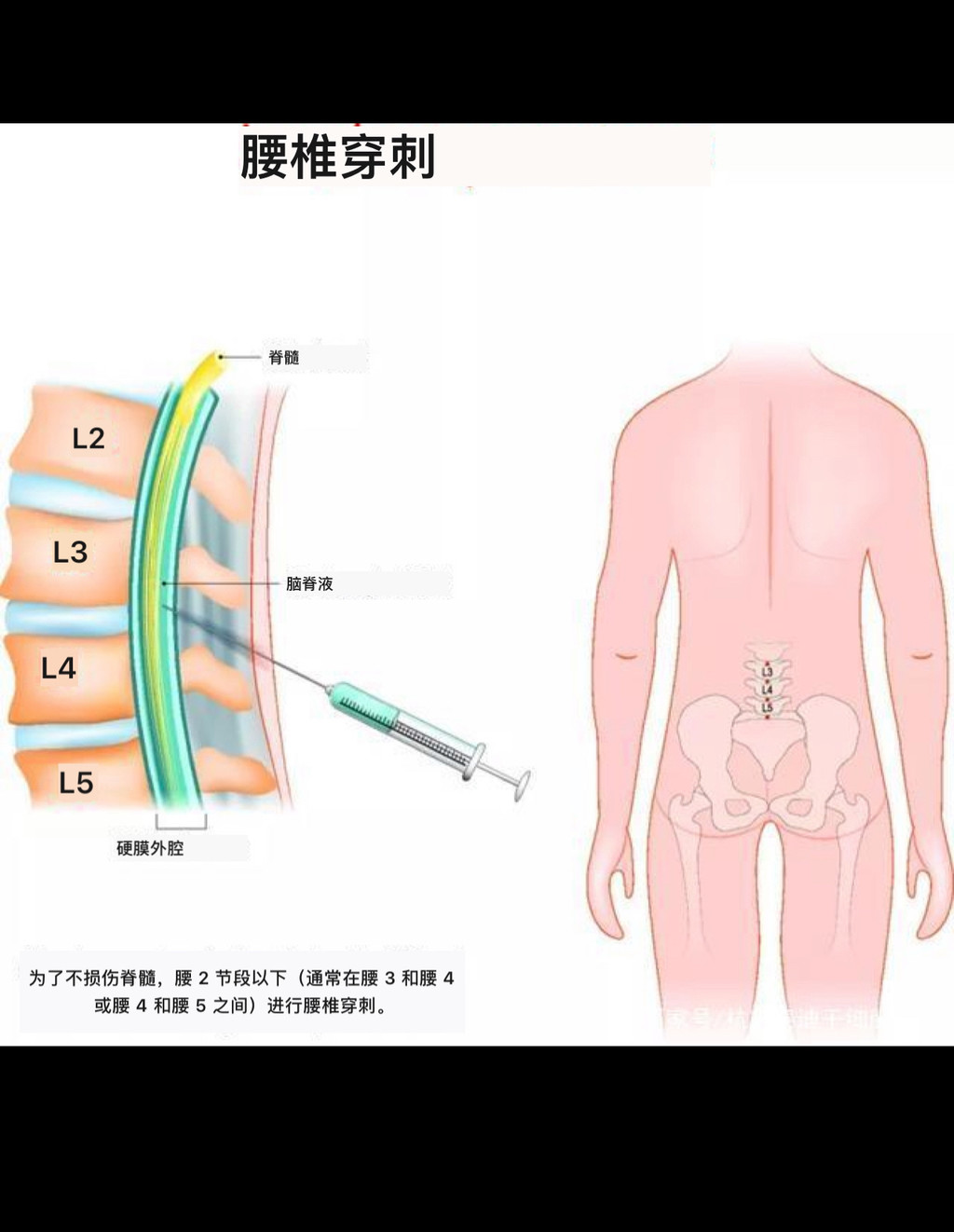 干细胞真能治瘫痪后遗症吗,干细胞治疗高位瘫痪有效果吗知乎