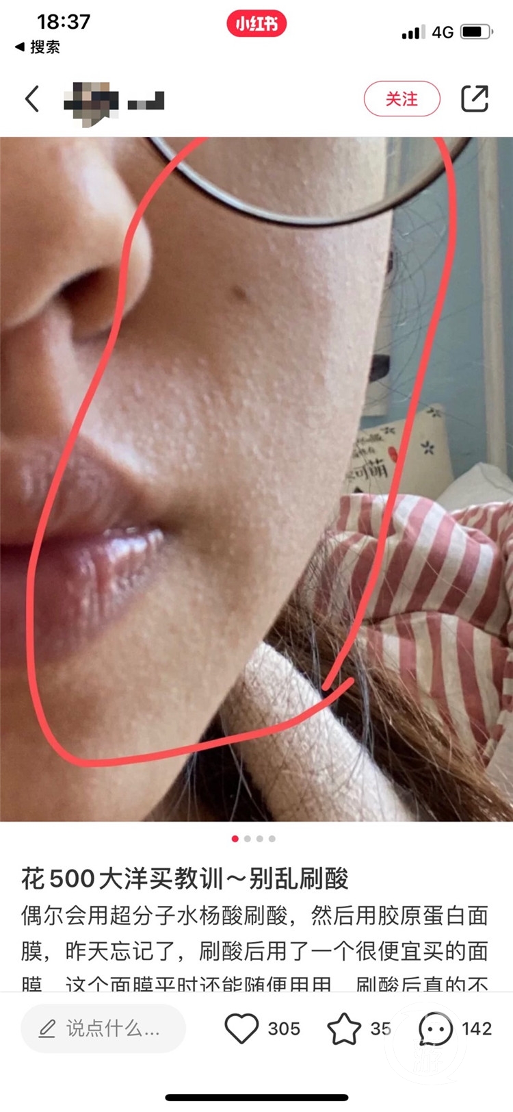 刷酸为什么会烂脸,水杨酸刷酸烂脸后的真实经历