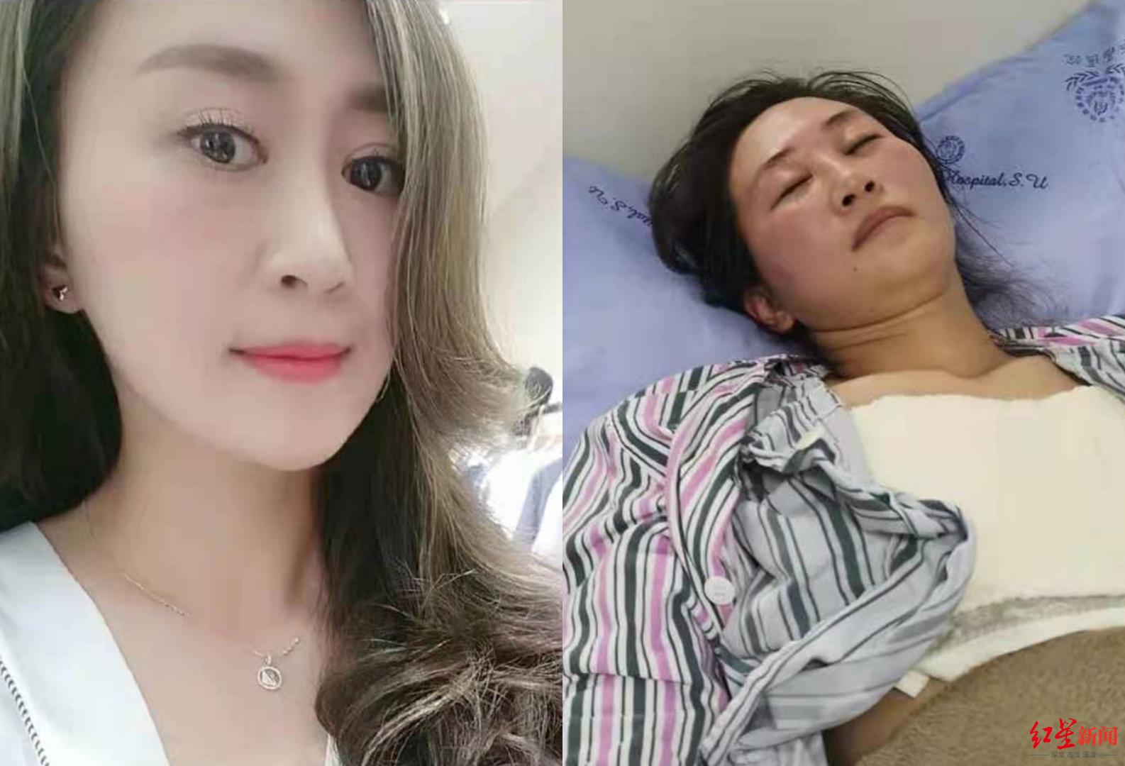 女子打美白针后续,女子打美容针后遗症