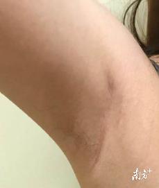 脖子甲状腺肿瘤怎么样做微创手术,无痕甲状腺手术