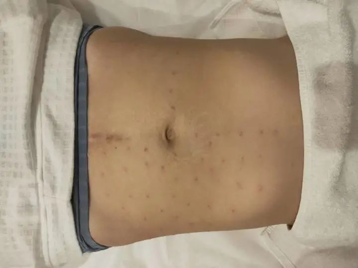 胸部填充手术,女胸部填充手术