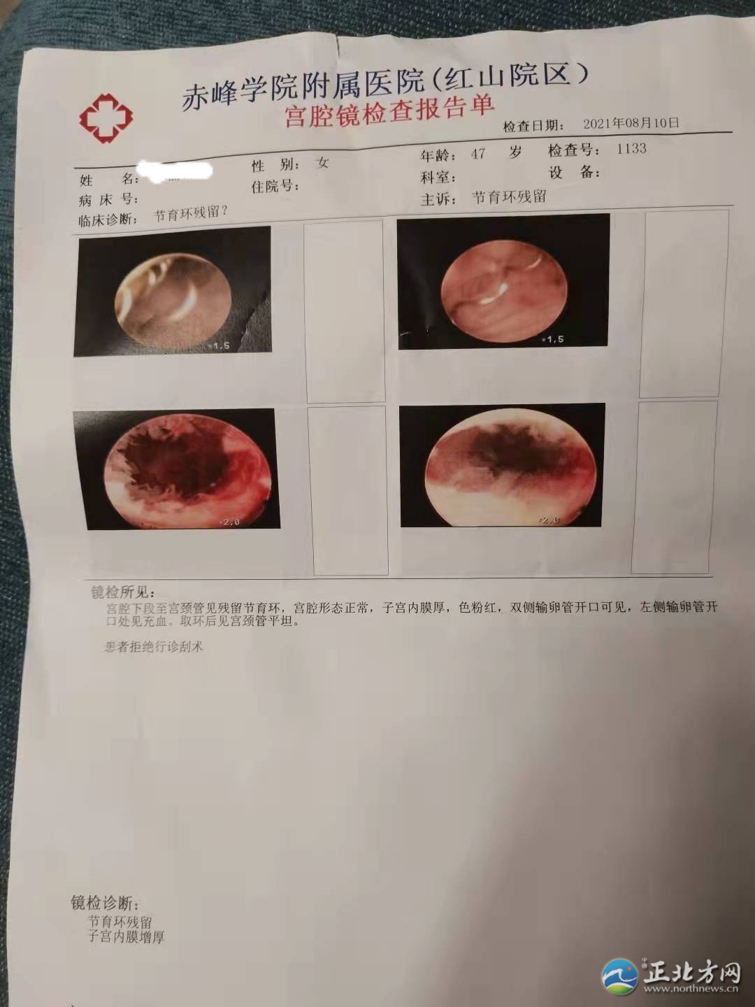 郭女士取环手术半年后环还在,记者采访被报警……