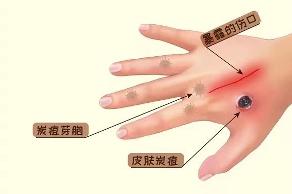 炭疽近期多发，如何预防？德州市疾控中心提醒：避免接触病死动物