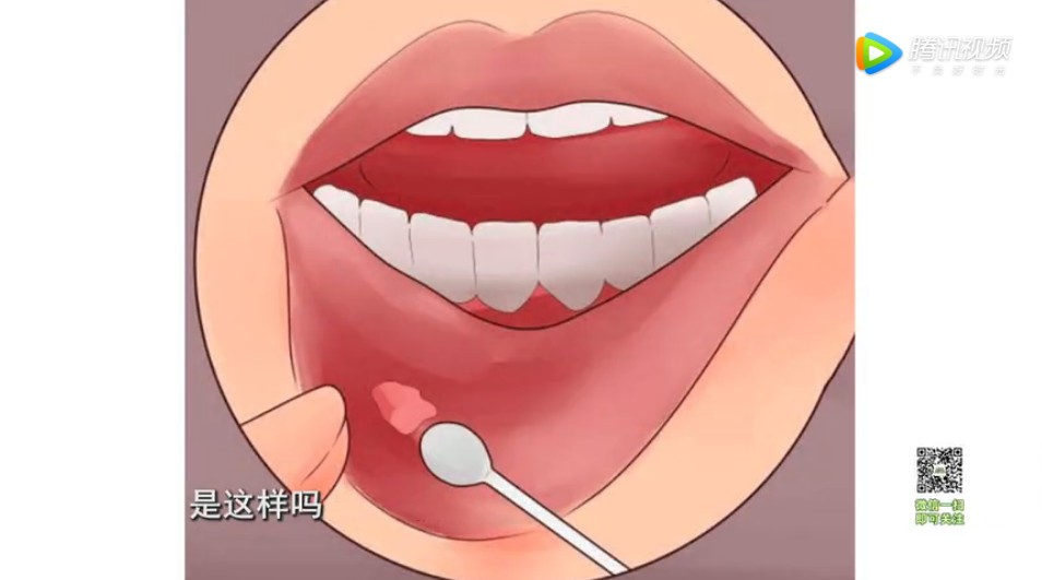 上颚口腔溃疡癌的症状,植物神经紊乱口腔溃疡多久会变癌