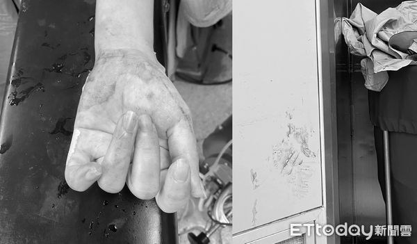 25医护救新生儿！「墙上都是血」婴全身发紫4张照逼哭网友