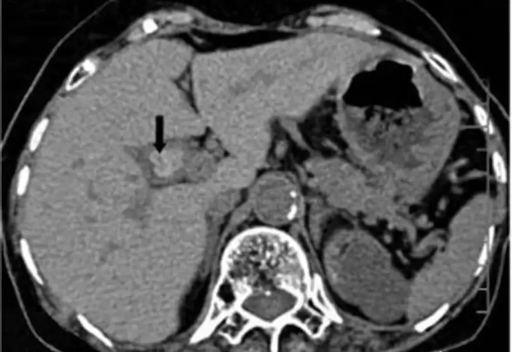 肠息肉切除好还是不切除好,肠息肉切除还是不切除好
