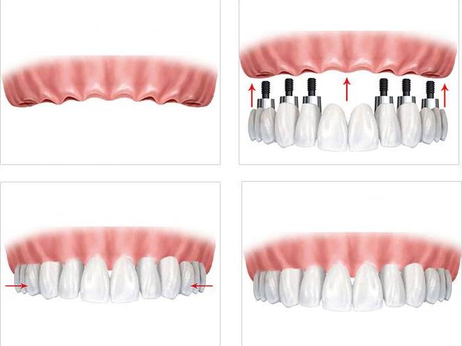 老年人种植牙需做哪些检查,老人种植牙齿注意事项