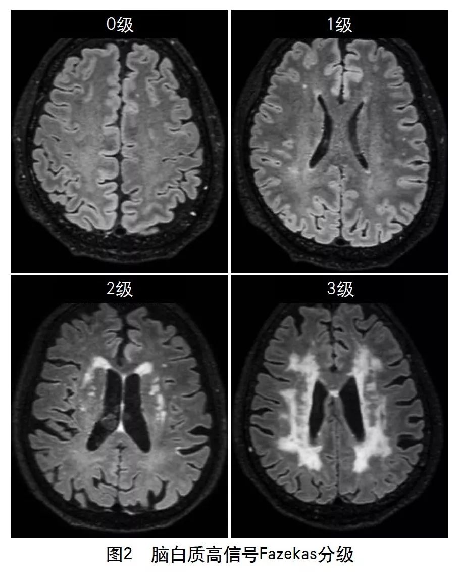 容易被误诊漏诊的脑小血管病,脑小血管病的基础知识
