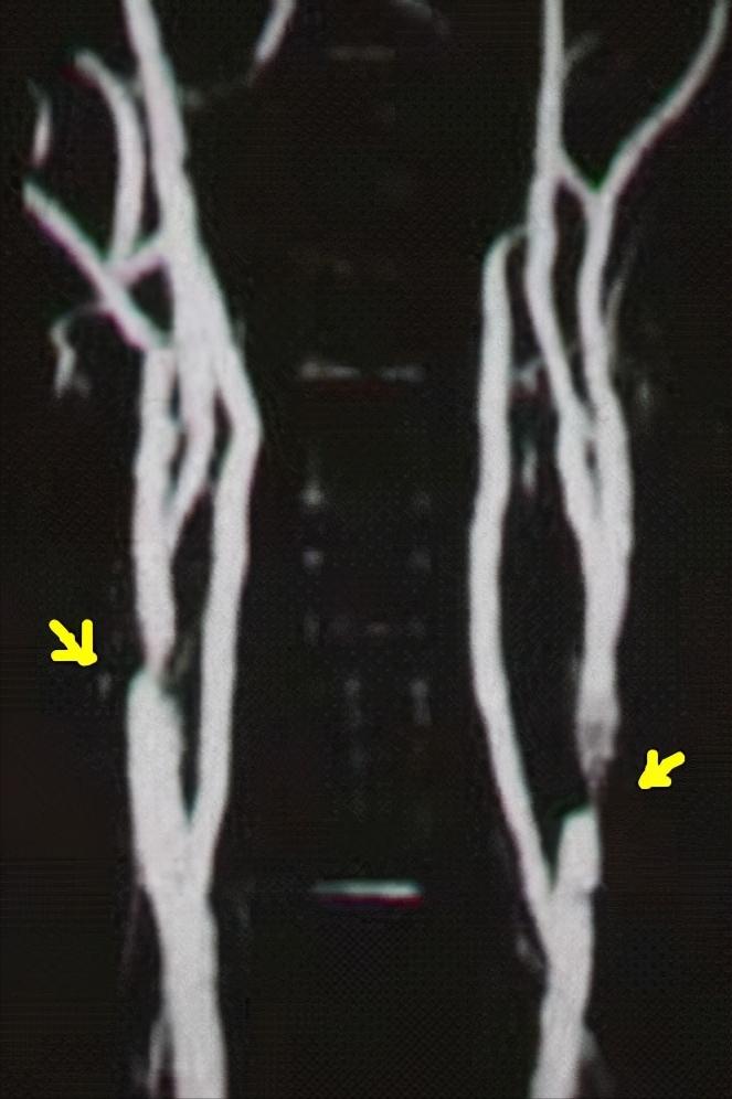 脑梗后癫痫会致人死亡吗,脑梗死的癫痫会引起牙齿痛吗