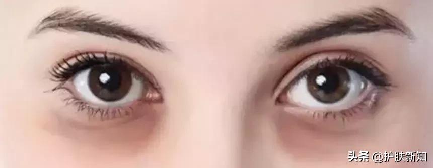 太有才了,竟然有人拿痔疮膏治疗黑眼圈