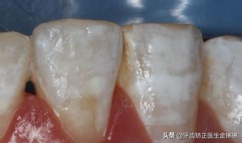 淄博的水氟斑牙,内蒙古氟斑牙是怎样形成的