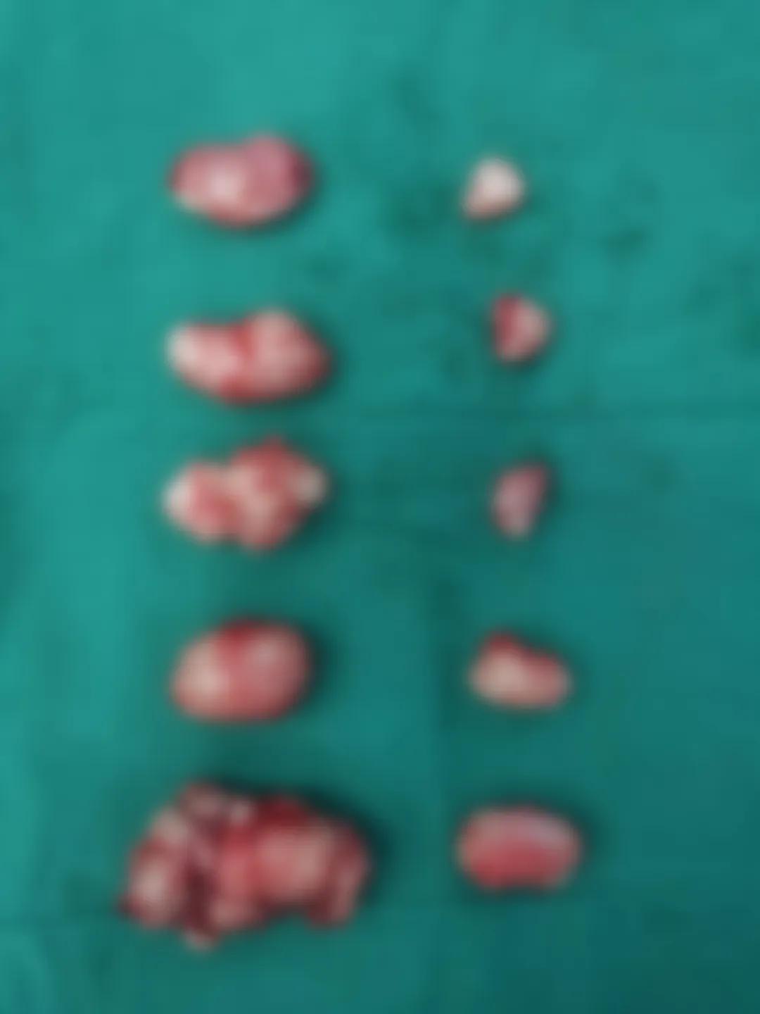 刚出生的婴儿身体里有个怪胎,单脐宝宝健康出生