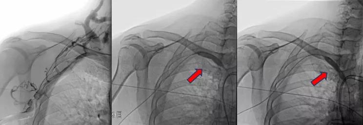 dsa食管狭窄球囊扩张术,经皮静脉超声引导下球囊扩张术