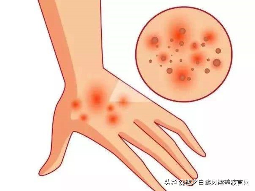 308激光治疗仪治白癜风多少钱一台,白癜风做308激光一个疗程为多少钱