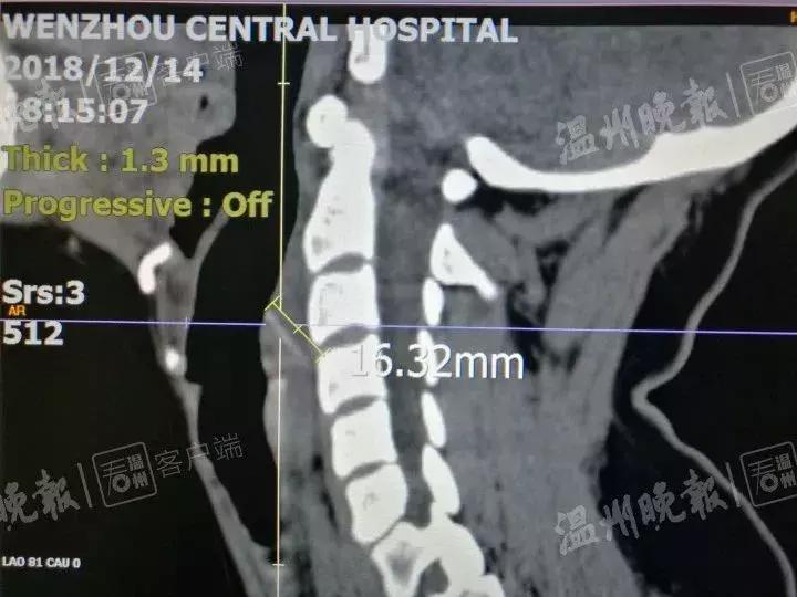 女子吃烧烤喉咙疼,吃完火锅喉咙痛10分钟女子抢救