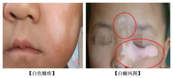 什么季节给孩子补锌最合适,给小孩补钙补锌有必要吗