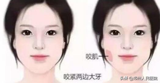 川字纹抬头纹鱼尾纹全脸年轻化,川字纹抬头纹鱼尾纹法令纹去除