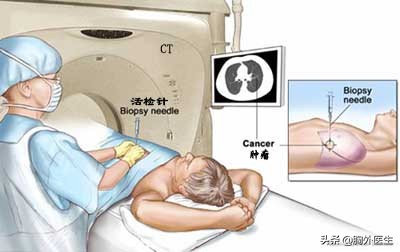 肺结节属于什么肺病,肺结节是什么病需要做化疗吗