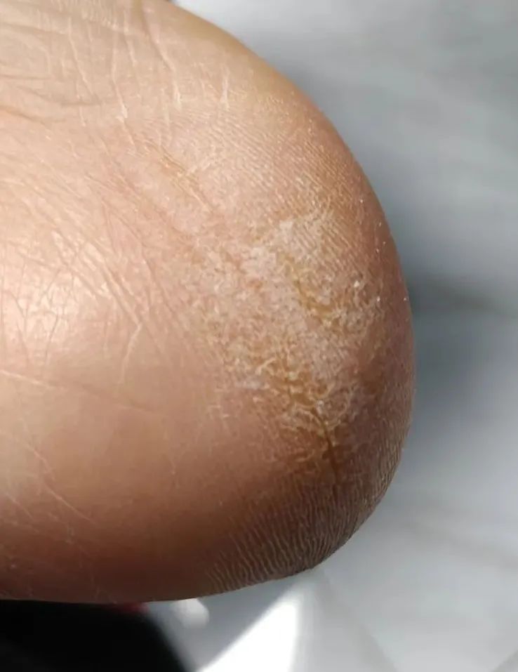 脚上干裂居然是真菌惹的祸