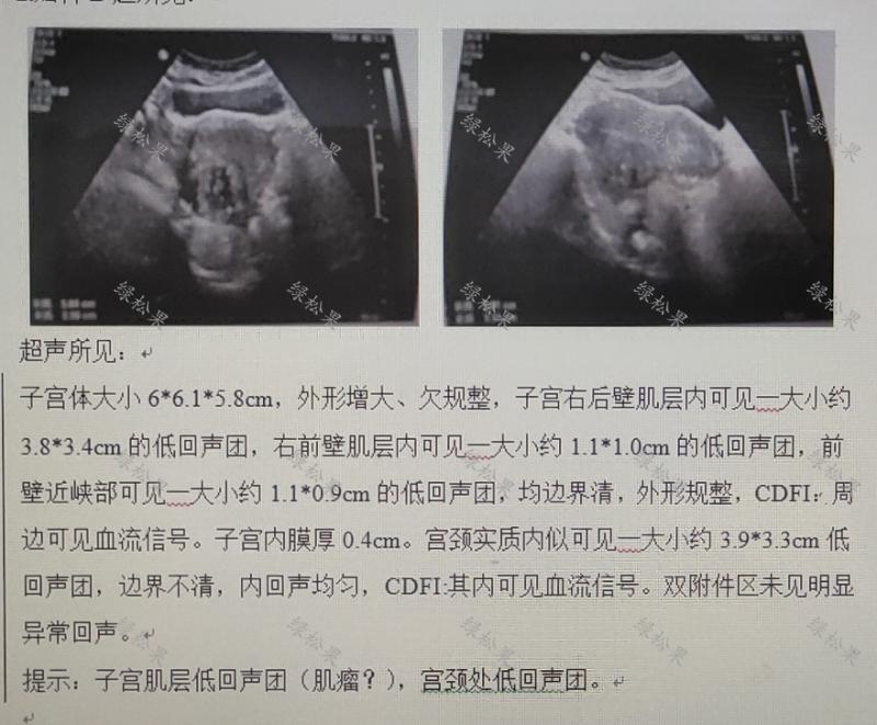 绝经后出血发现是子宫内膜癌,绝经几年了下身出血是宫颈癌吗