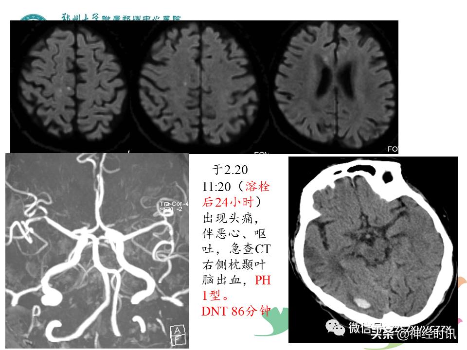 静脉溶栓怎么引起的,静脉相关并发症的预防及处理