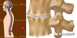 72岁老人腰疼还有骨刺该怎么治疗,老年人骨刺疼痛怎么治疗