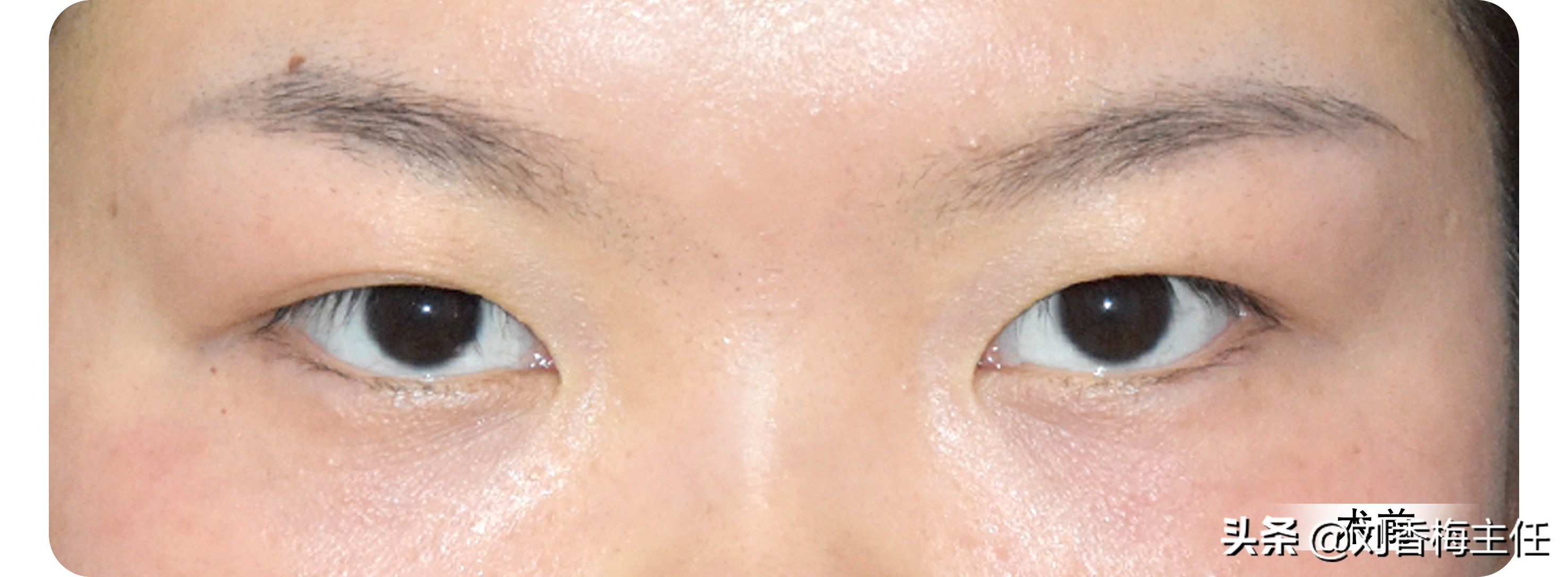 双眼皮恢复过程中不一样宽正常么,三点定位双眼皮恢复10天过程图