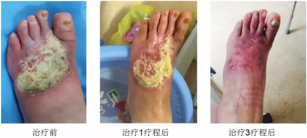 干细胞治疗的疾病及原理,瑞金医院白塞病干细胞移植