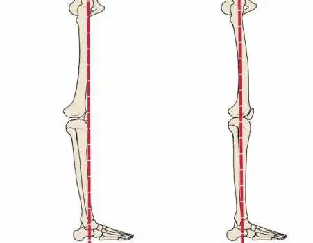 膝超伸腿粗运动可以改善吗,大粗腿膝超伸矫正方法图解