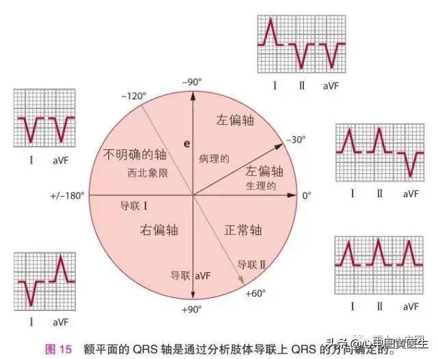 心电图中qrs顺钟转位什么意思,心电图什么是qrs顺钟转位