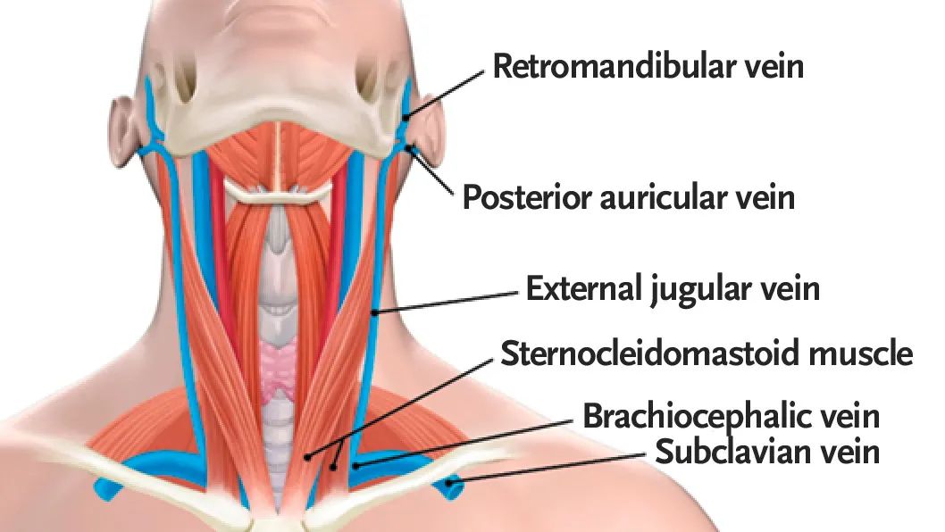 颈内静脉穿刺术禁忌,颈内静脉穿刺术教学视频