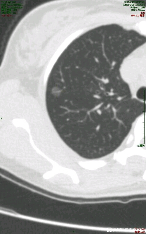 考虑微浸润性腺癌算确诊吗,考虑微浸润性肺腺癌可以看好吗