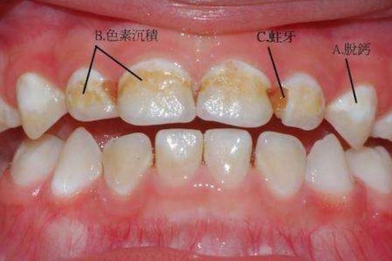 牙齿松动牙槽骨吸收必须得拔牙吗,牙周炎导致牙齿松动一定要拔牙吗