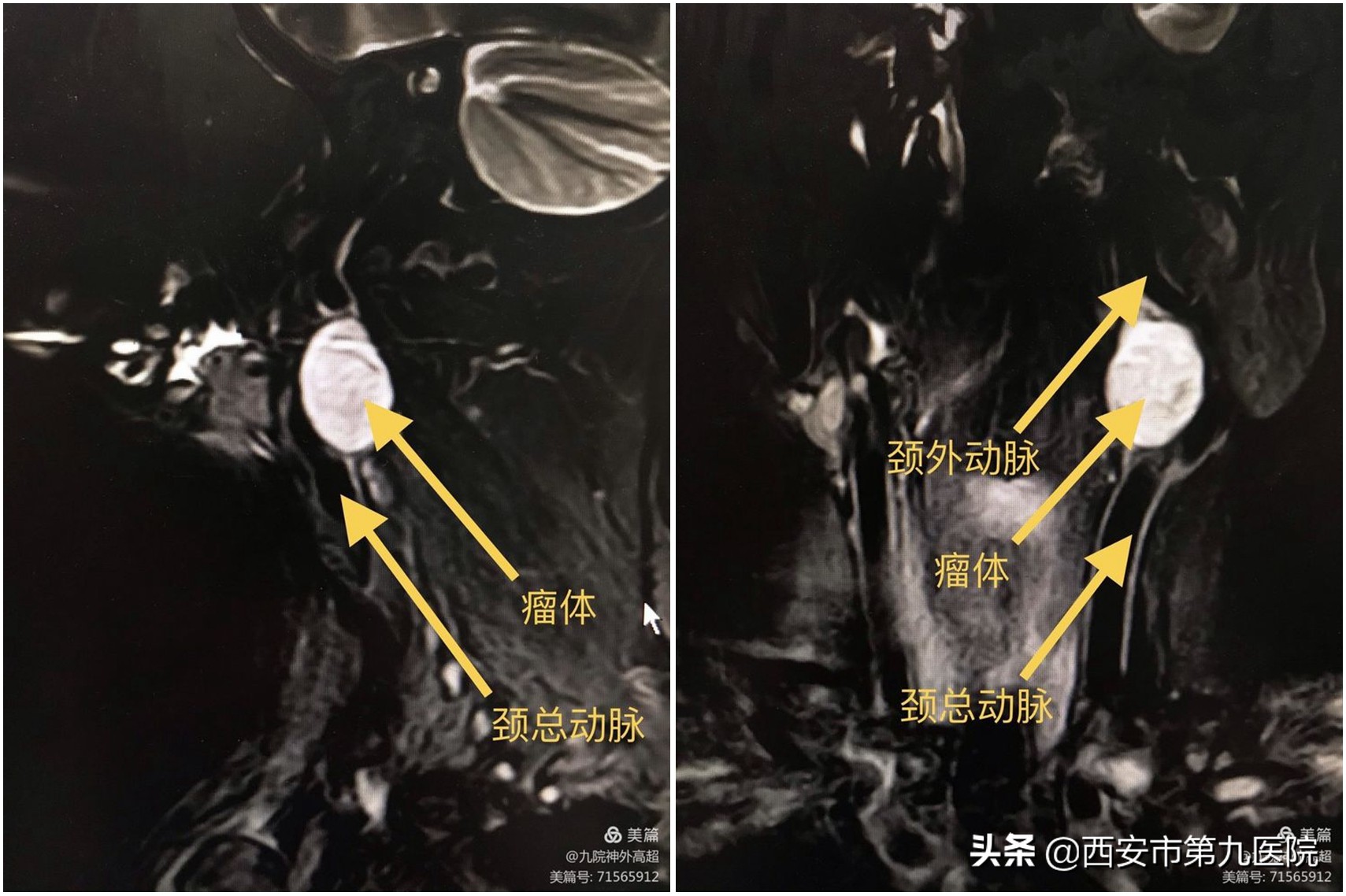 脖子上长一个神经瘤需要手术吗,颈动脉上有个凸起疑是动脉瘤