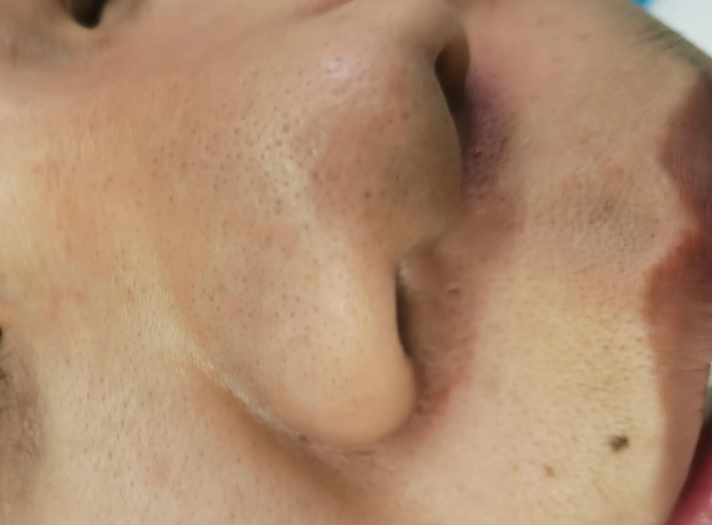 整形医生做面部美容视频,鼻头鼻翼缩小术的真实案例