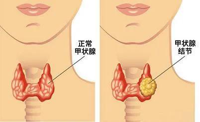 甲状腺结节良性消融治疗优缺点,甲状腺结节4a穿刺良性的怎么治疗