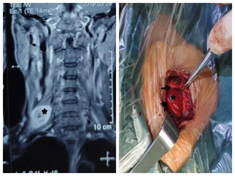 小包块大*弹炸**骨科专家来拆除——西安市中心医院院骨一科成功拆除一例特殊臂丛神经鞘瘤