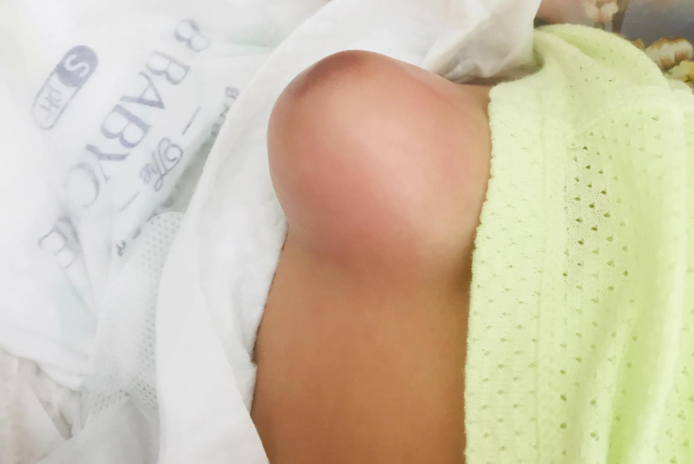 肚脐凸出来,十有八九是脐疝,大多会自愈