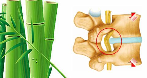 腰椎间盘突出躺在床上腿还疼,腰椎间盘突出了为什么腿会疼