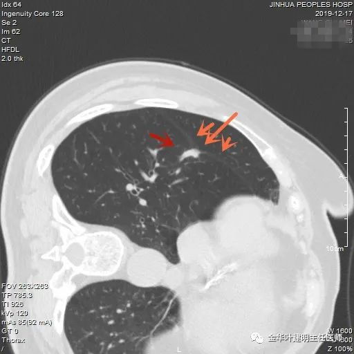 叶建明谈实性结节,叶建明肺实性良性结节会变癌症吗