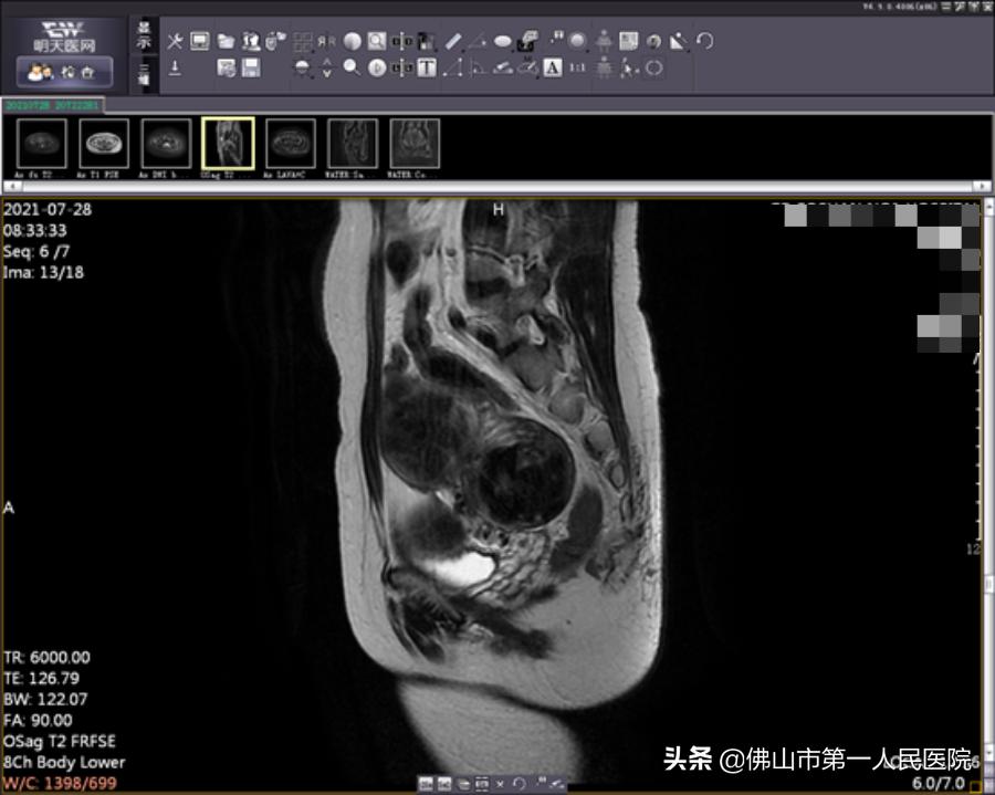 这把“刀”能隔山打“牛”,呵护子宫,带来好“孕”