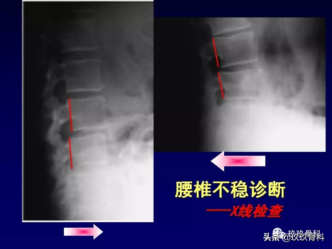 腰椎不稳最坏的结果,腰椎不稳的最佳治疗方法