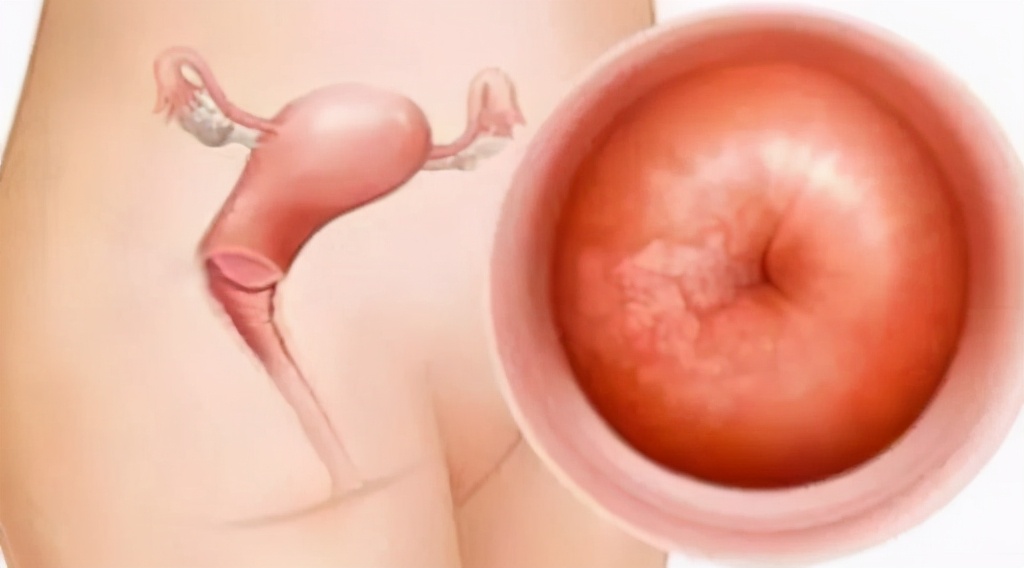 白带异味宫颈糜烂,白带有异味宫颈口有点瘙痒